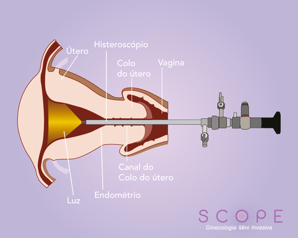 Doenças que o exame de videohisteroscopia pode identificar - Scope  Ginecologia